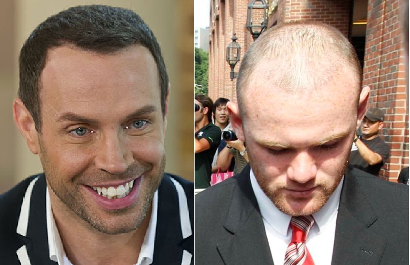 Celebrity Hair Transplants Before And After