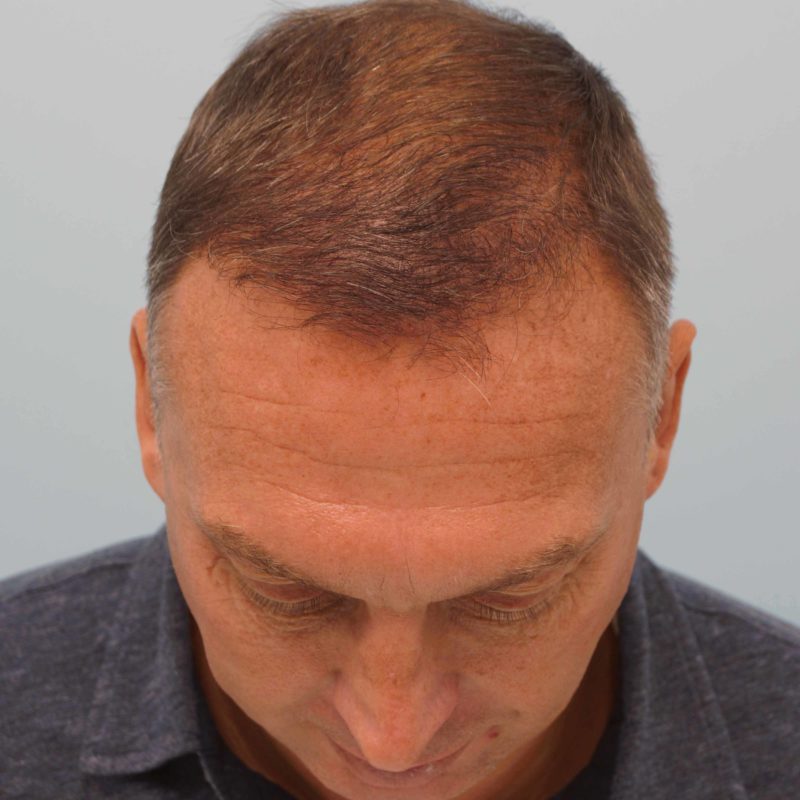 David Platt Hair Transplant Results | Farjo Hair Institute