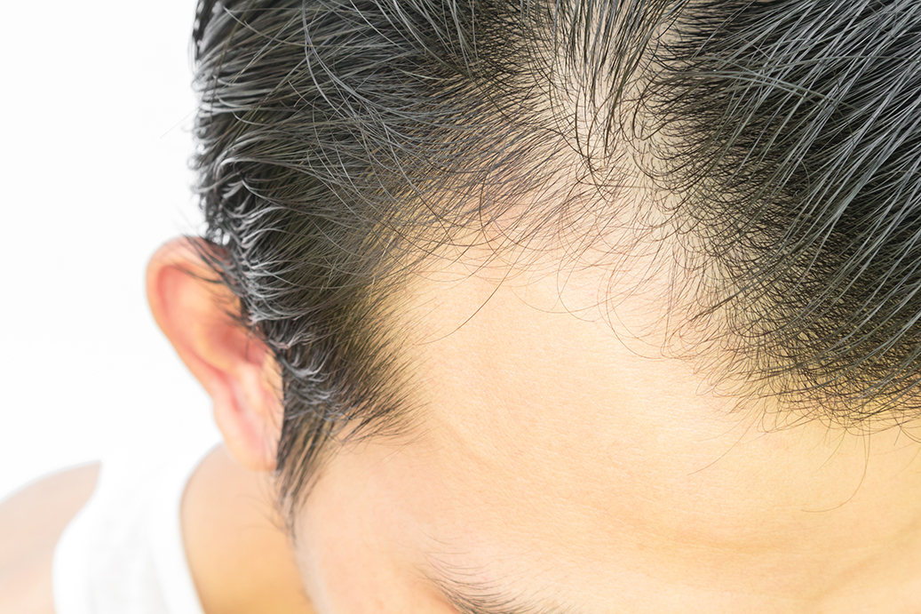Are you a good candidate for hair transplant surgery? - Dr Bonaros